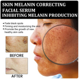 ✨Fast Dark Spot Remover-NESLEMY™ Melanin Correcting Facial Serum